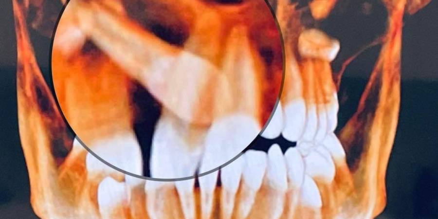 Leczenie ortodontyczne kłów zatrzymanych aparatem stałym?  Czy to możliwe? 