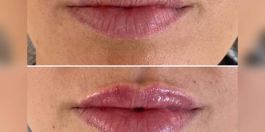 Odrobina kwasu hialuronowego 